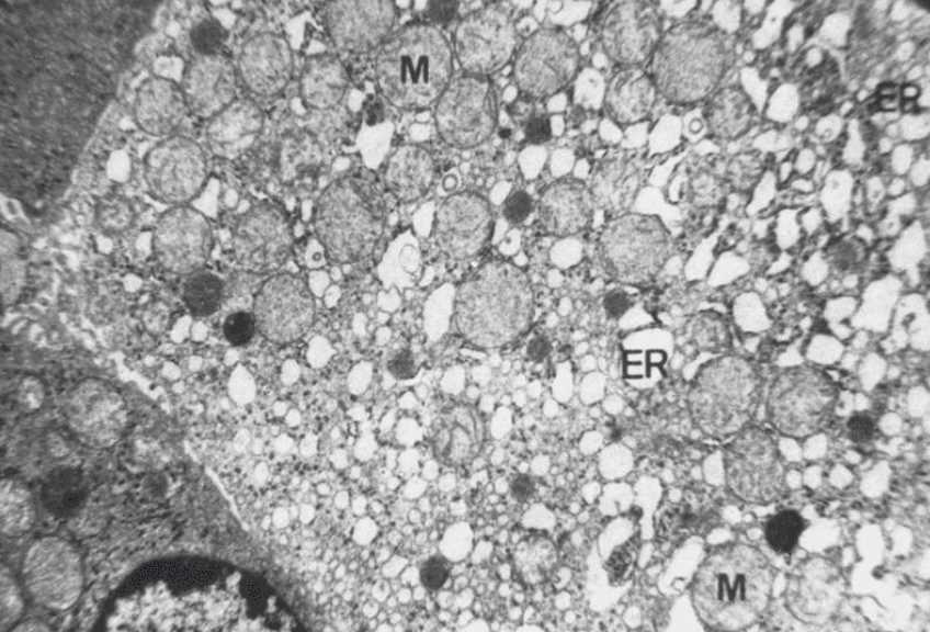 Electron microscopic images of hepatocyte injury
