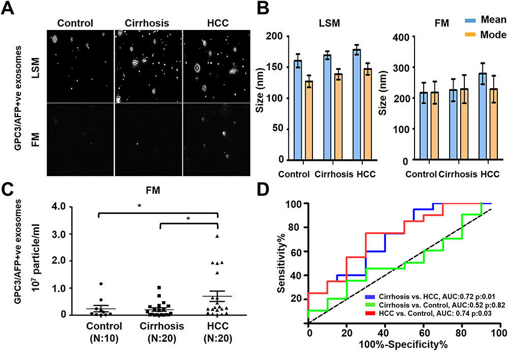 AFP and GPC3 double-positive exosome quantification in HCC via immunocapture, size analysis, serum comparison, and ROC evaluation.