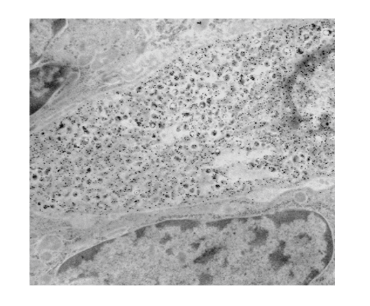 Protein A gold labeling of a prostatic endocrine-paracrine cell demonstrating localization of calcitonin (inset) to the neuroscretory granules.