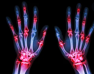 Progress on Photoacoustic Molecular Imaging in Diagnosis and Treatment of Rheumatoid Arthritis