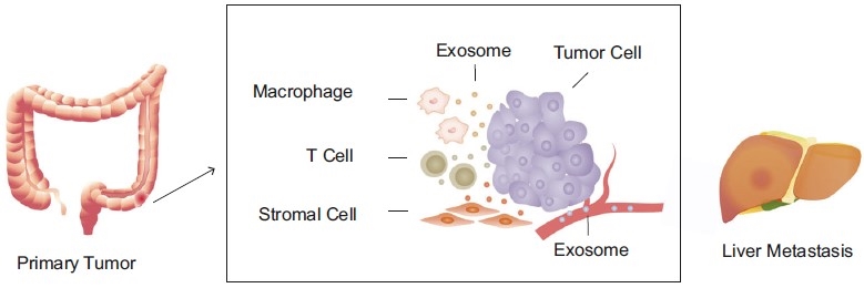 Exosomes in liver metastasis of colorectal cancer.