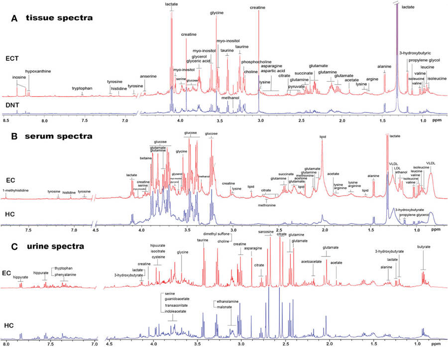 1H NMR-based metabolomics of paired tissue, serum and urine samples reveals an optimized panel of biofluids metabolic biomarkers for esophageal cancer.