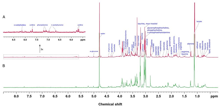 HRMAS NMR metabolomics applied to endometrial cancer tissue characterization.