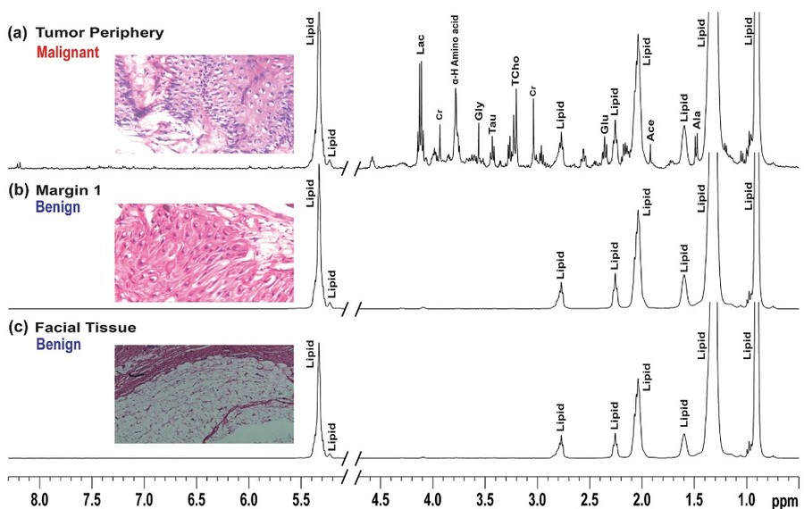Malignancy prediction among tissues from Oral SCC patients including neck invasions: a 1H HRMAS NMR based metabolomic study.