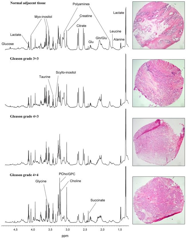 Spermine and citrate as metabolic biomarkers for assessing prostate cancer aggressiveness.