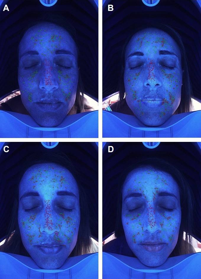 Imaging shows facial pigmentation before rose stem cell exosome treatment and its reduction at weeks 3, 6, and 12 in a 44-year-old female patient.
