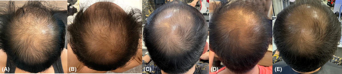 Progressive hair regrowth and density improvement from baseline to 3 months after exosome therapy in male pattern hair loss.