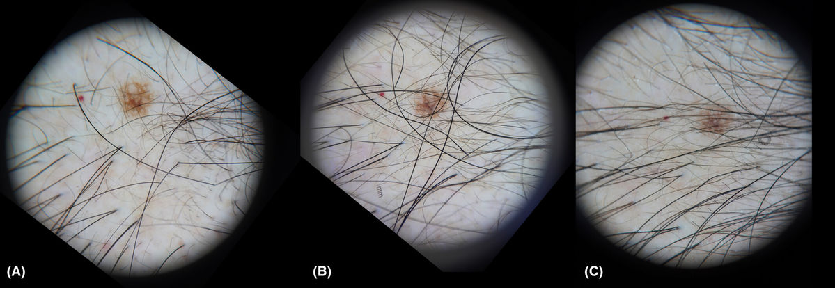 Dermoscopic images showing hair improvement at baseline, after 6 and 12 exosome treatments using skin marks as reference points.